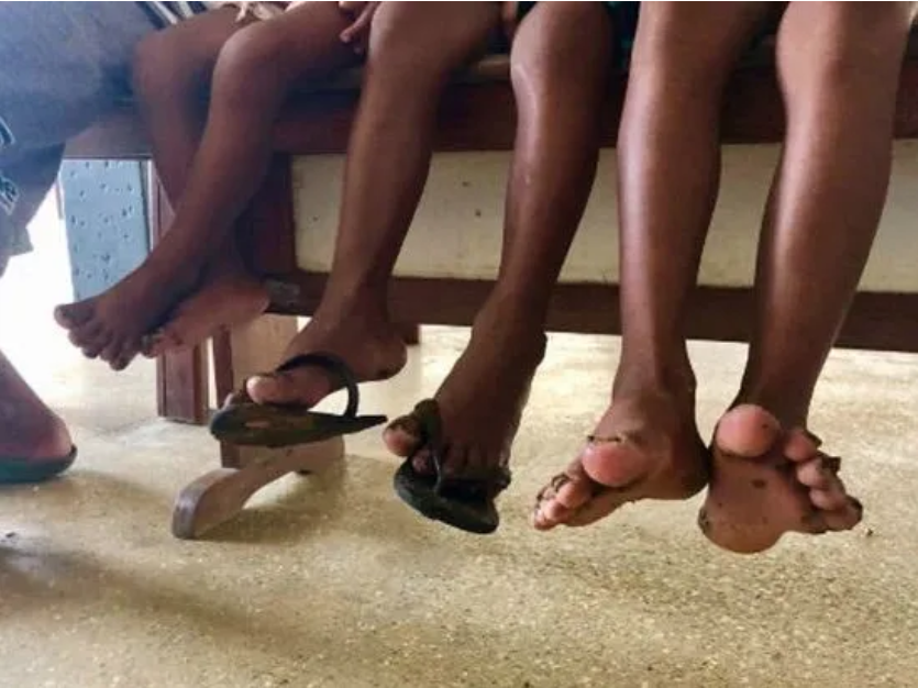 Tungiasis Sand Flea disease Training of health workers at national and district levels on skin-NTDs