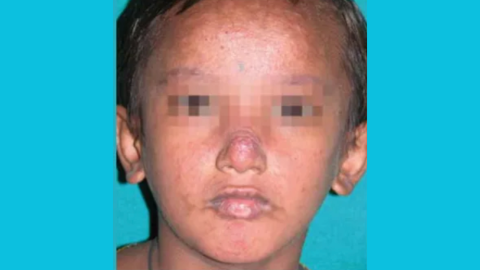 Post-kala-azar dermal leishmaniasis: training of health workers on skin-NTDs